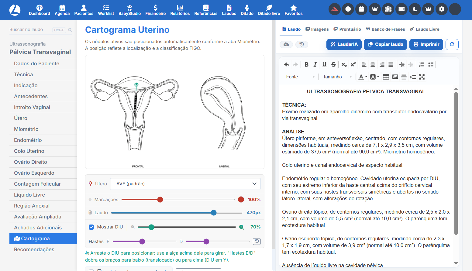 Cartograma pélvico com útero e ovários