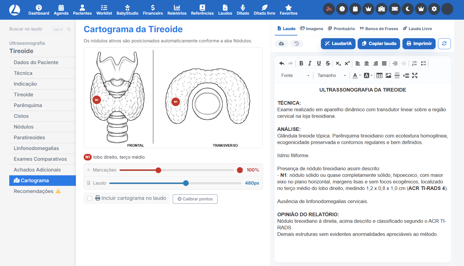 Cartograma da tireoide com classificação TI-RADS